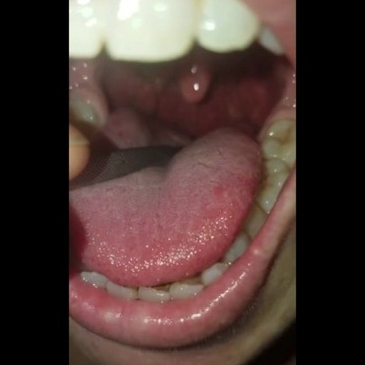 Woman open mouth tour with thick uvula